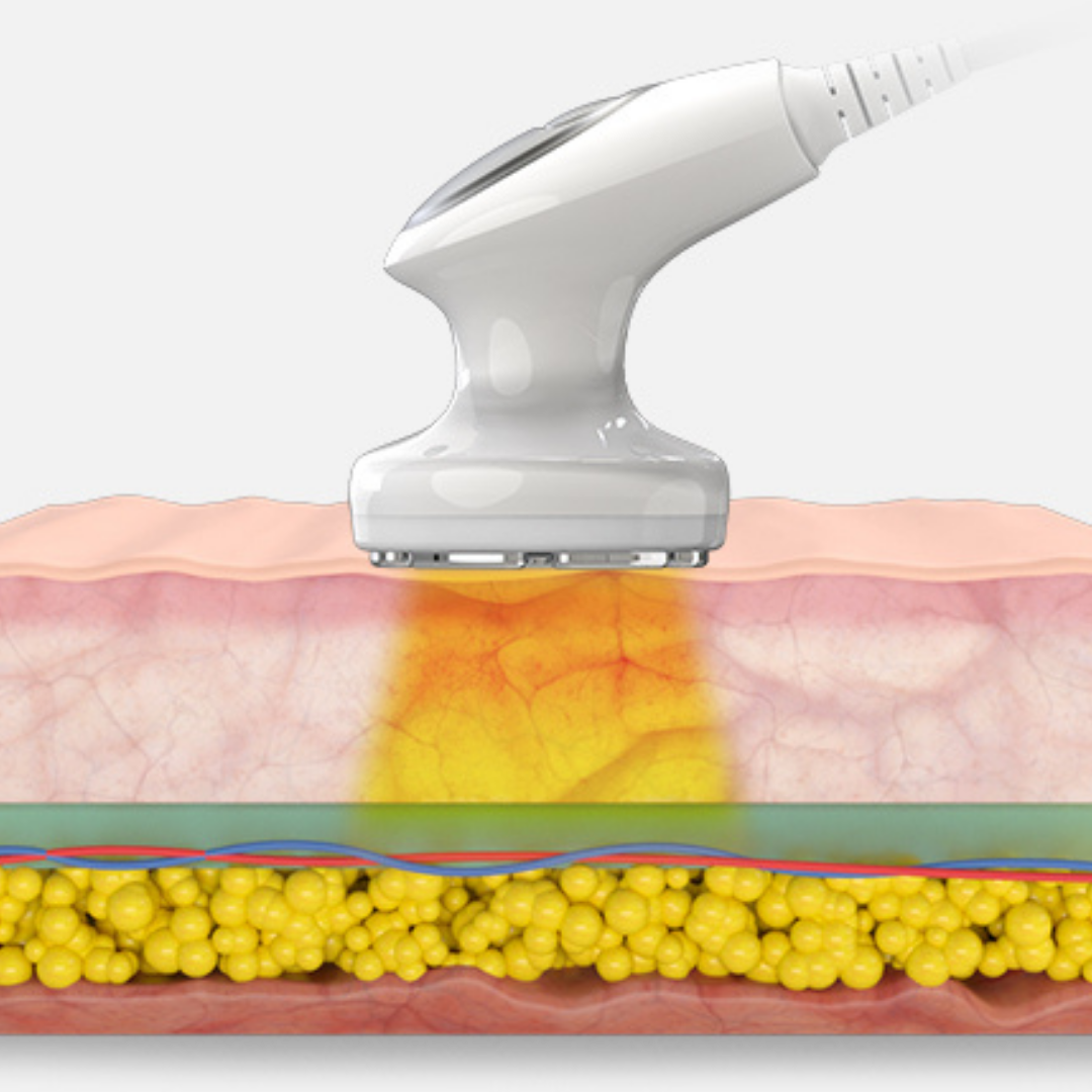 Soft Laser-Lipolaser